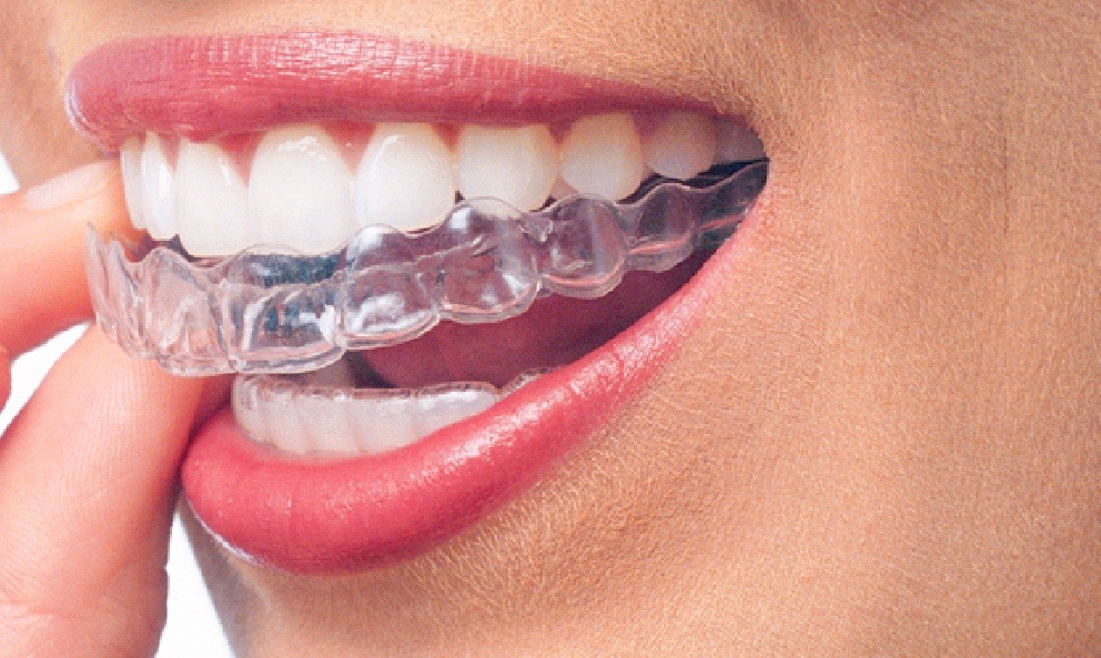 clear braces 